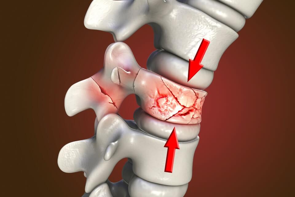 Simple Clinical Tool Can Help Diagnose Spinal Fractures In People With 